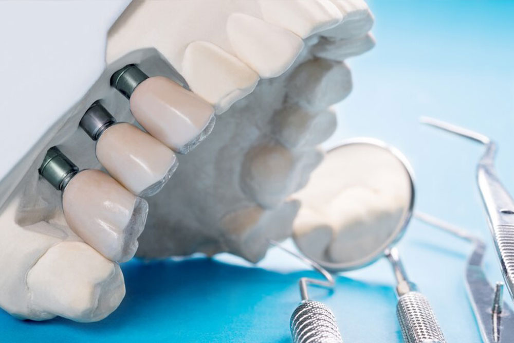Пластика ясен, імплантація зубів, видалення зуба мудрості