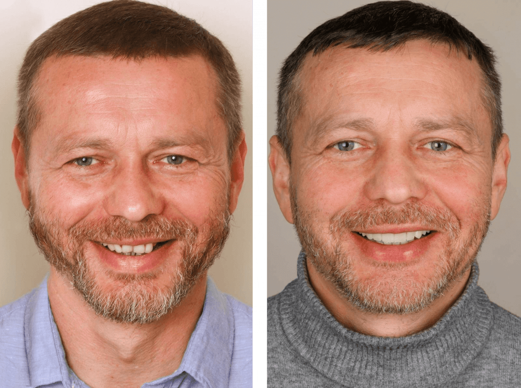 Встановлення керамічних вінірів фото до і після