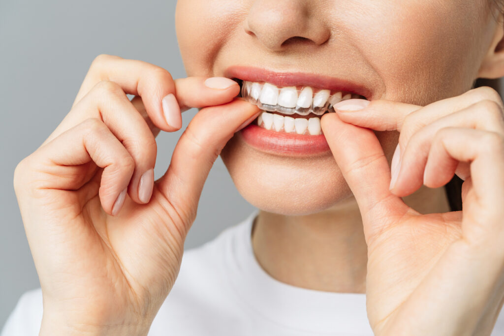 A young woman does a home teeth whitening procedure. Whitening tray with gel.
